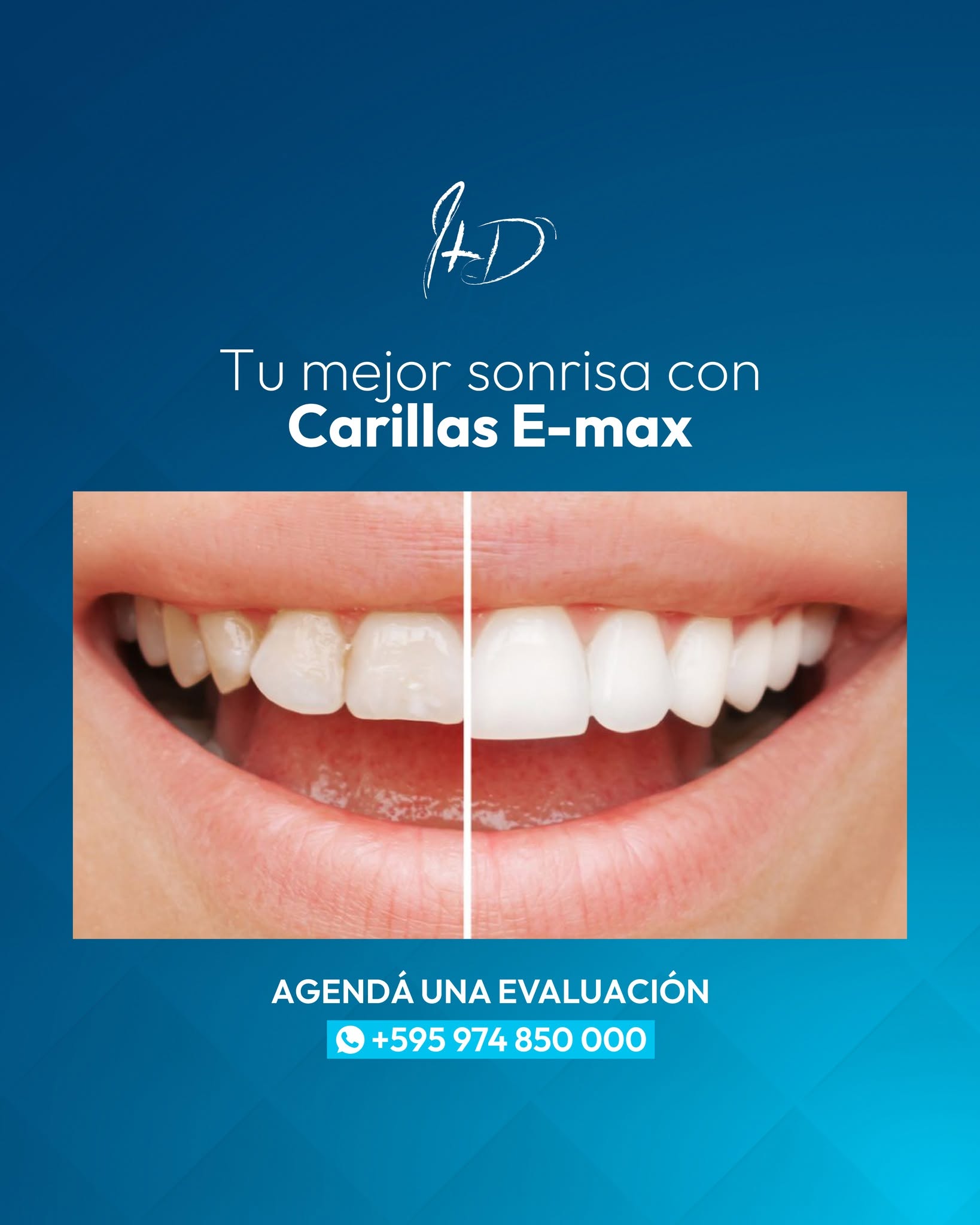 Antes y después de carillas dentales E-max, caso real de Ivaskevich Design Odontología