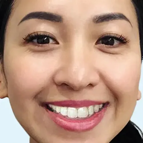 Sonrisa de mujer después del tratamiento de ortodoncia