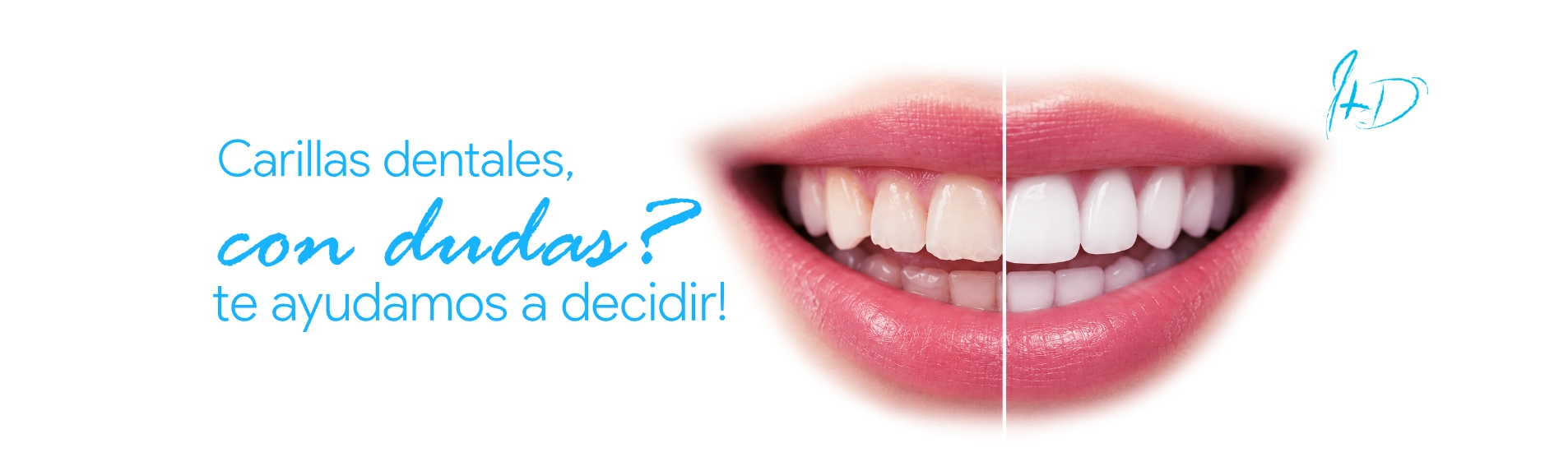 Carillas dentales, con dudas, te ayudamos a decidir — Ivaskevich Design Odontología, Encarnación