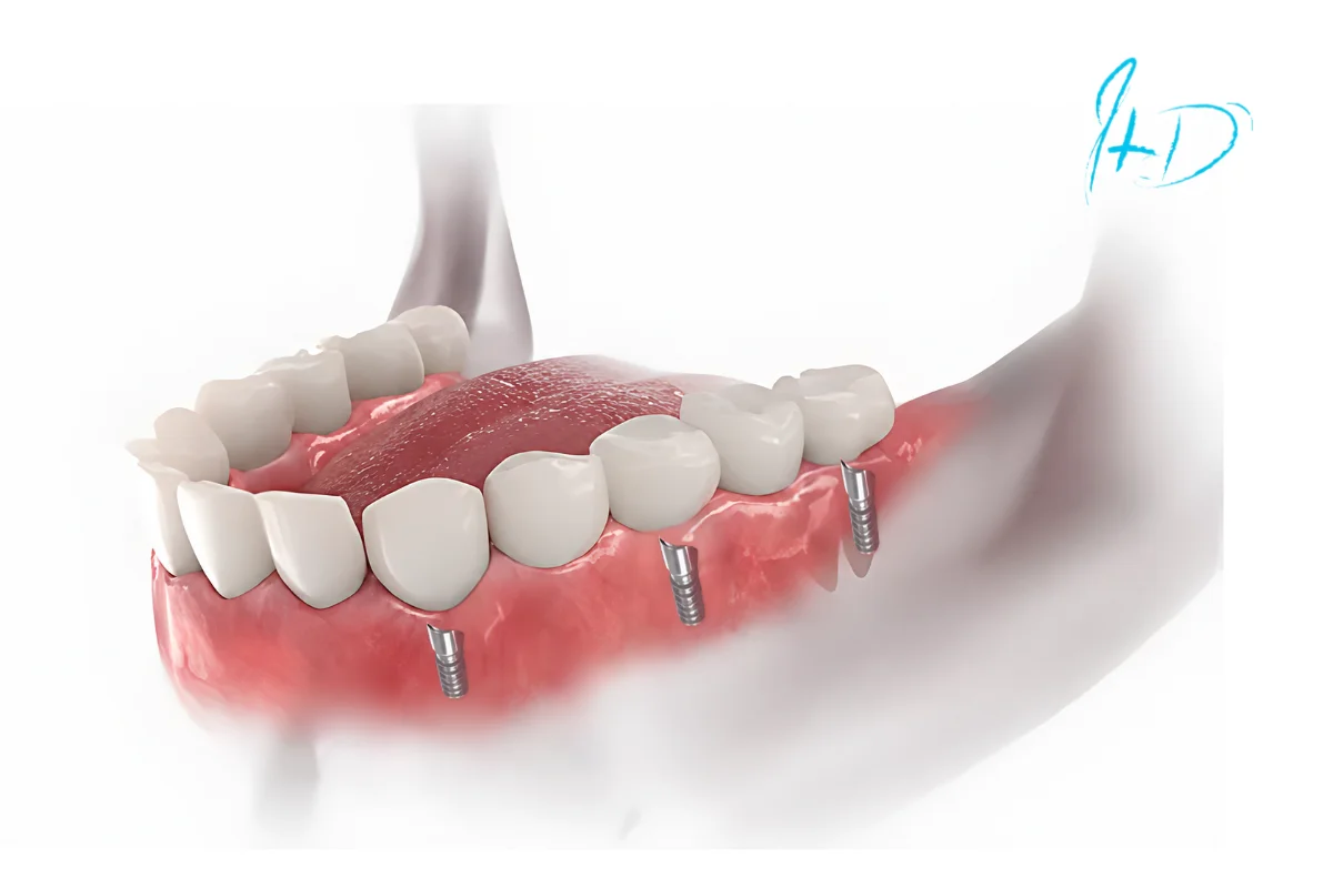 Esquema de implantes dentales colocados en el maxilar inferior, Ivaskevich Design Odontología